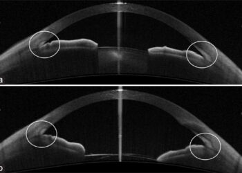 Διφωσφονικά και Κίνδυνος Οξέος Γλαυκώματος Κλειστής Γωνίας: Μια Προσεκτική Εξέταση