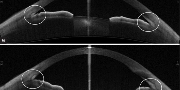 Διφωσφονικά και Κίνδυνος Οξέος Γλαυκώματος Κλειστής Γωνίας: Μια Προσεκτική Εξέταση
